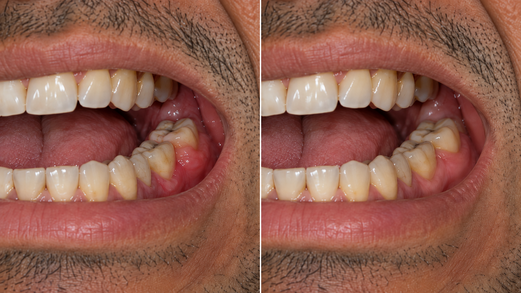 Before and after: Gum Inflammation